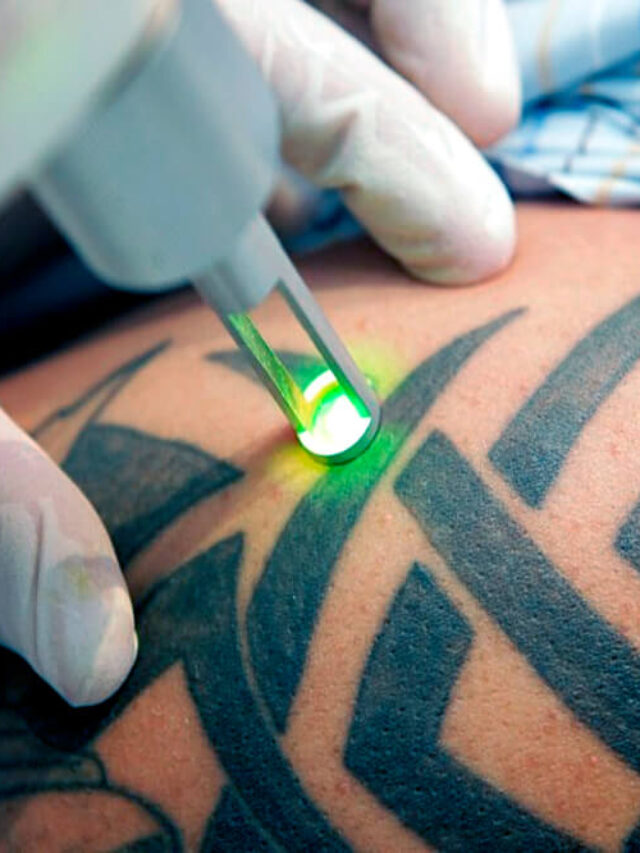 Laser Tattoo Removal Melbourne