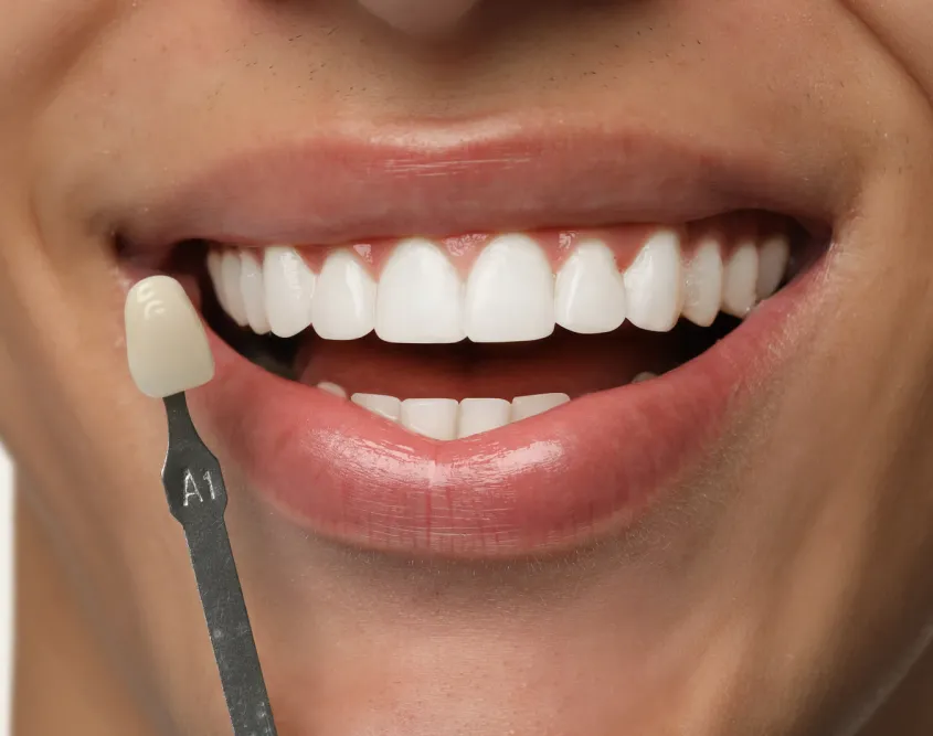 Veneers Melbourne